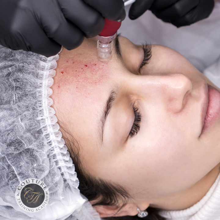 microneedling3